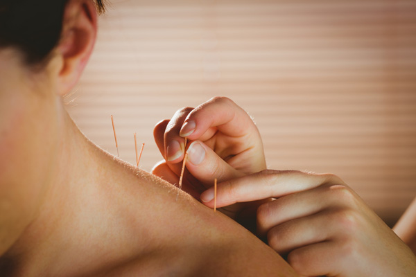 What Is Dry Needling And How Does It Work?